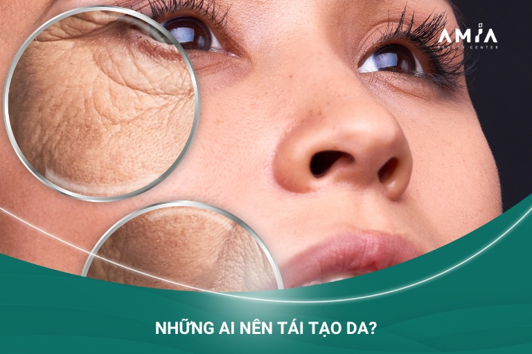 Những bạn sở hữu làn da nám sạm, xỉn màu, thâm sau mụn, lão hóa,... nên tái tạo da