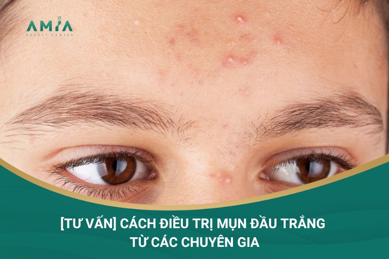 [Tư vấn] Cách Điều Trị Mụn Đầu Trắng Từ Các Chuyên Gia