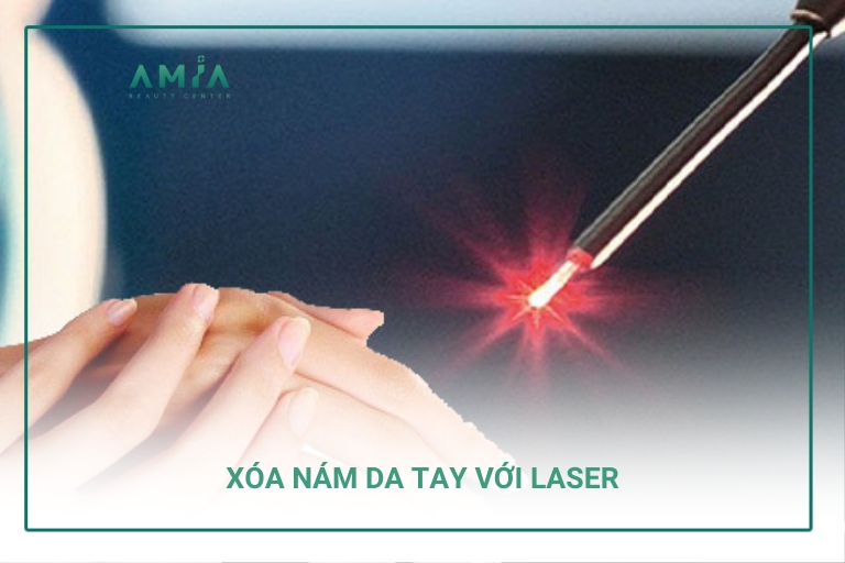 Xóa nám da tay với công nghệ laser