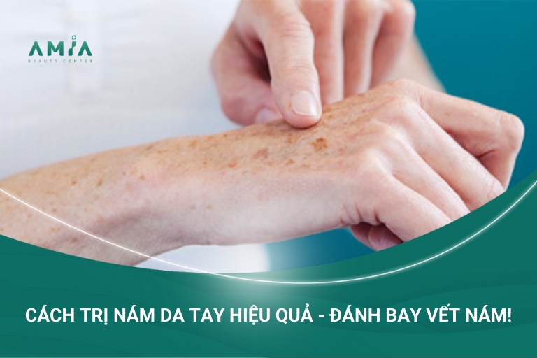 Cách Điều Trị Nám Da Tay - Đánh Bay Vết Nám!