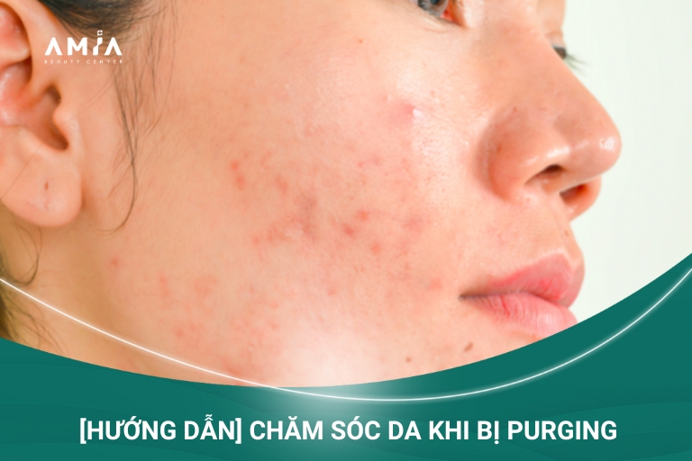 [Hướng Dẫn] Chăm Sóc Da Khi Bị Purging