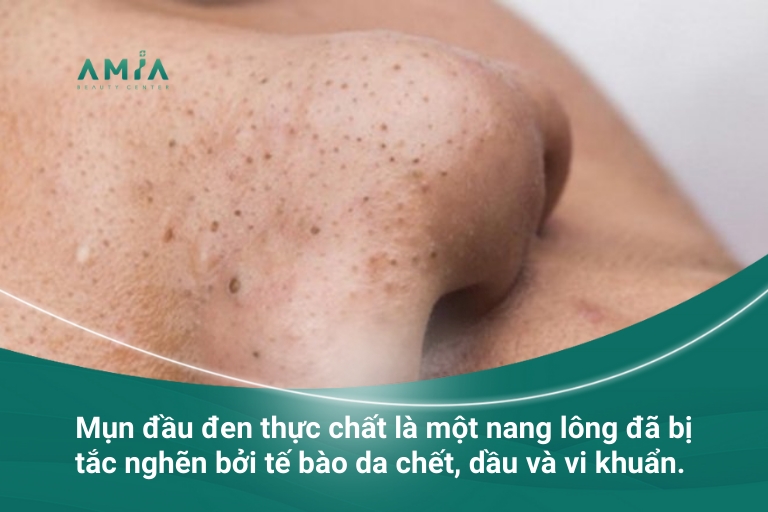 Mụn Đầu Đen Là Gì? Cách Chăm Sóc Da Mụn Đầu Đen Da-mun-dau-den