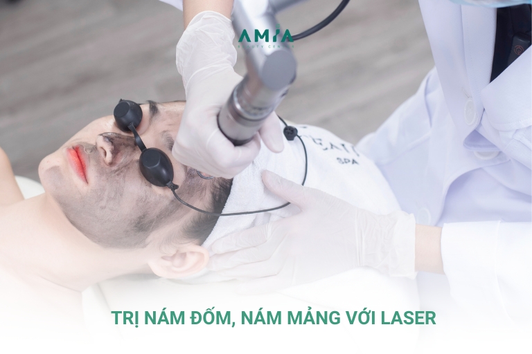 Trị nám đốm, nám mảng với công nghệ laser mang lại hiệu quả cao và nhanh chóng