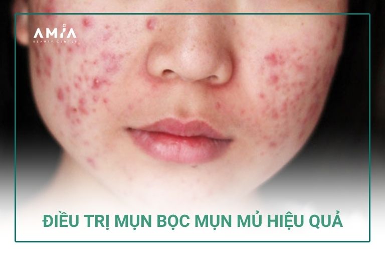 Điều trị mụn bọc mụn mủ hiệu quả