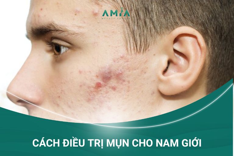 Điều trị mụn cho nam