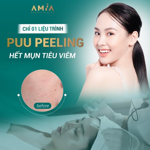 Hiểu đúng về dịch vụ PUU Peeling tại Amia