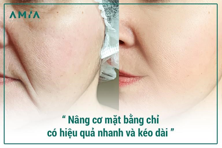 Nâng cơ mặt bằng chỉ