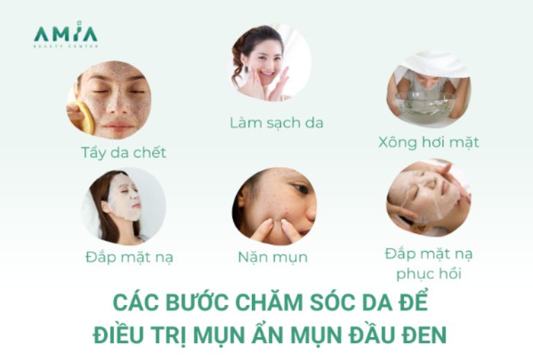 Các bước chăm sóc da điều trị mụn ẩn mụn đầu đen