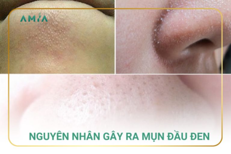 Các nguyên nhân dẫn đến mụn đầu đen
