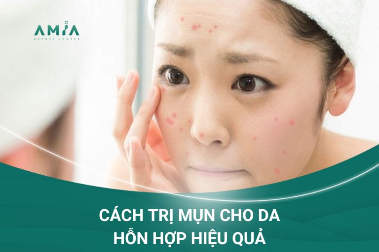 Cách trị mụn cho da hỗn hợp hiệu quả