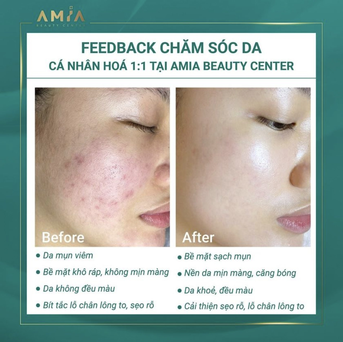 Hình ảnh khách hàng trước và sau chăm sóc da chuyên sâu tại Amia Beauty Center