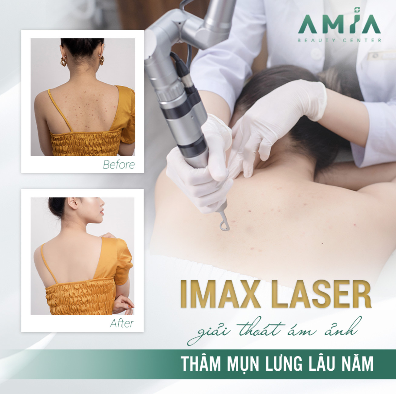 Dịch vụ trị thâm body IMAX Laser giúp xóa bỏ vết thâm sạm nhanh chóng, an toàn