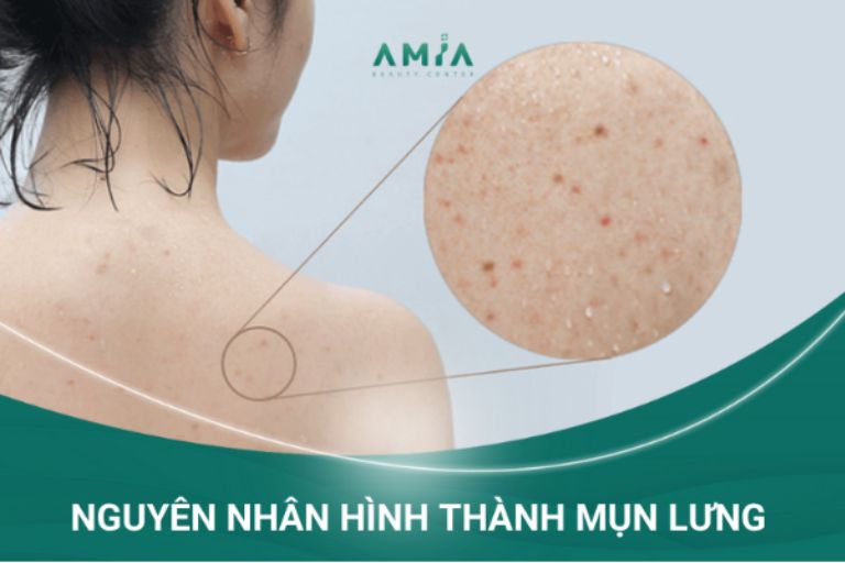 Nguyên nhân gây hình thành mụn lưng