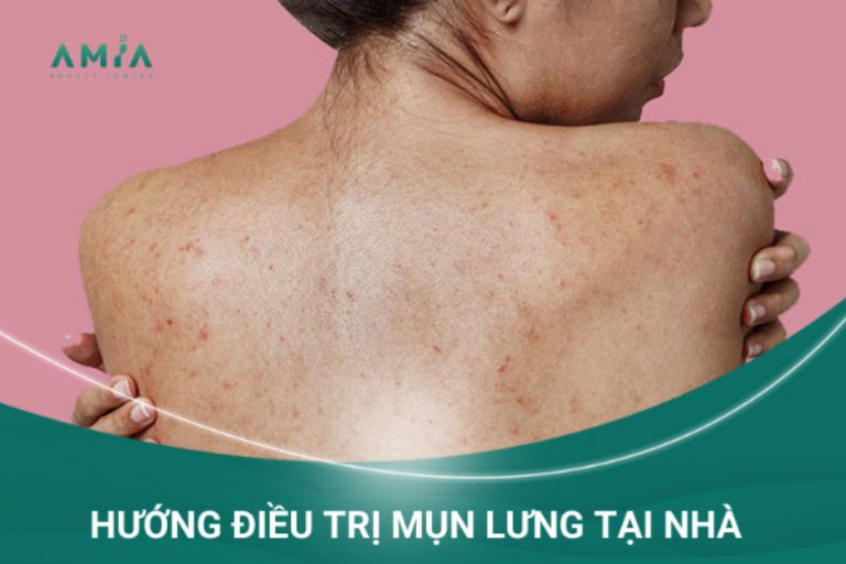 Một số cách điều trị mụn lưng tại nhà