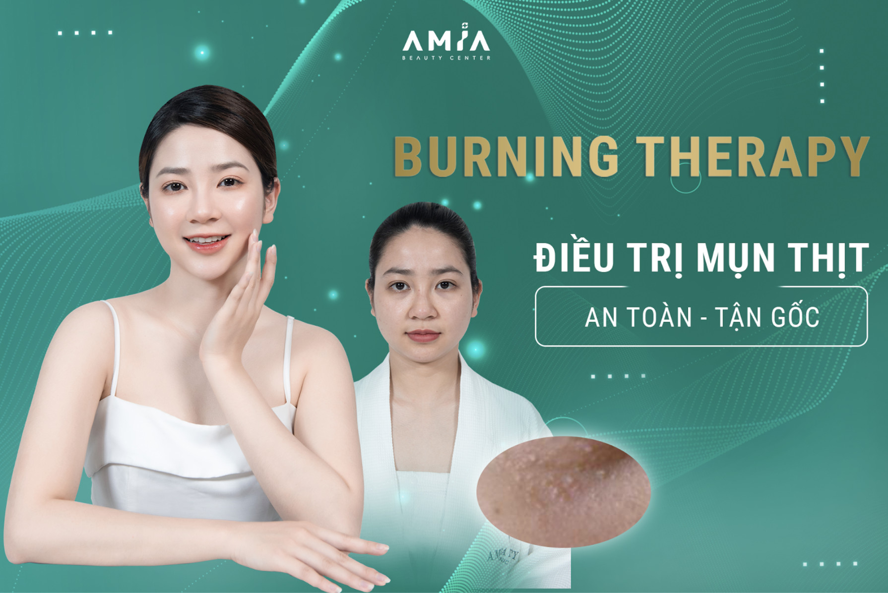 Liệu trình Burning Therapy điều trị mụn thịt an toàn - tận gốc