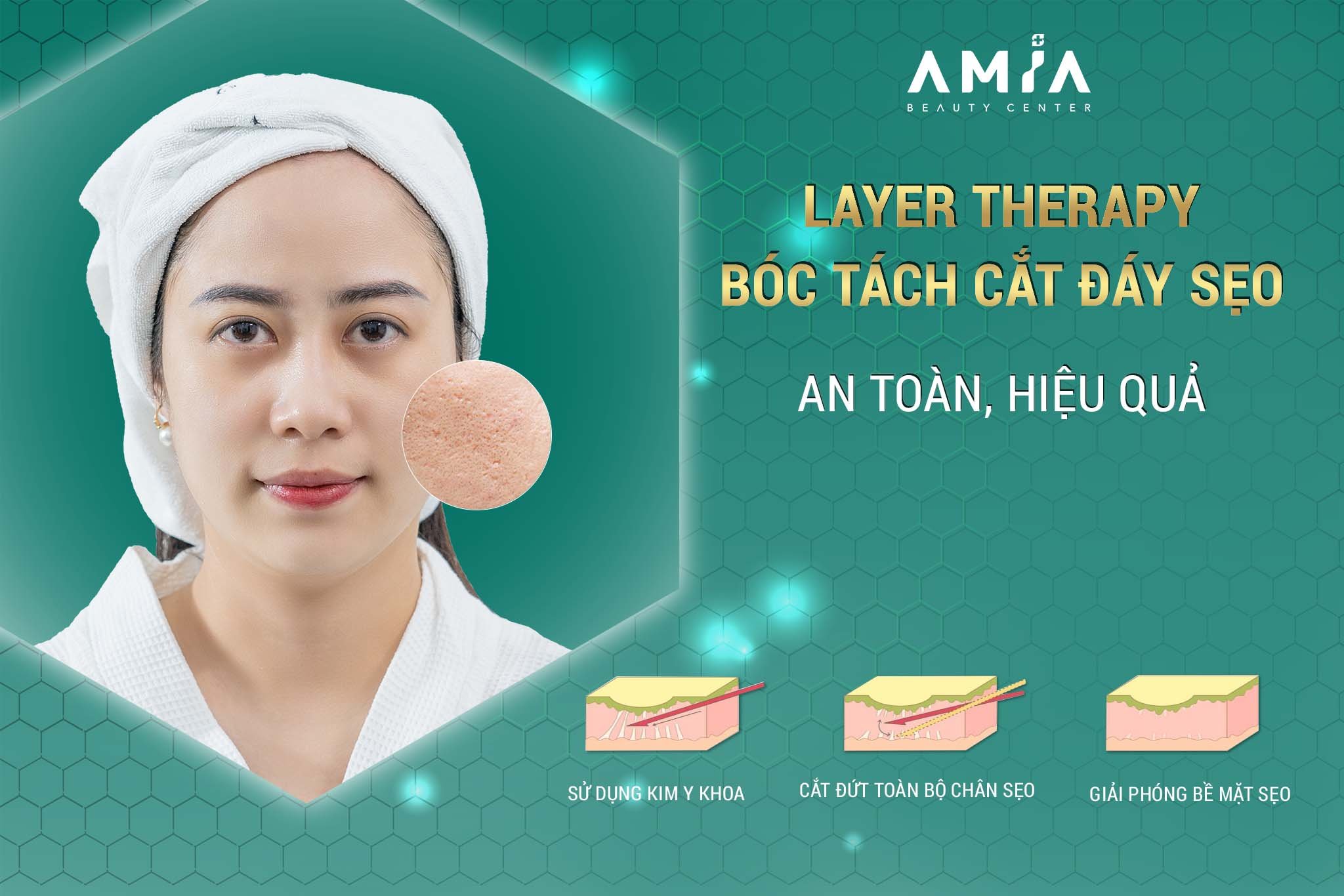 Liệu Pháp Layer Therapy Bóc Tách Cắt Đáy Sẹo: Liệu Trình, Chi Phí Và Lưu Ý