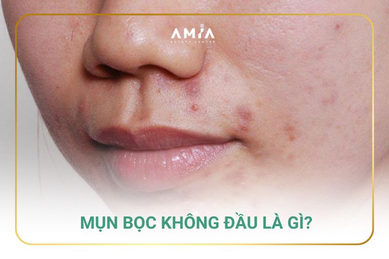 Mụn bọc không đầu là gì