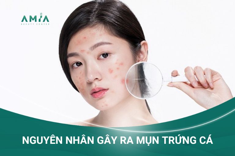 Có nhiều nguyên nhân dẫn đến mụn trứng cá