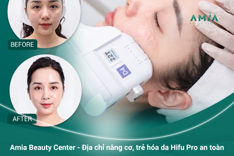 Tham khảo liệu trình nâng cơ, trẻ hóa da Hifu Pro an toàn, giá hợp lý tại Amia Beauty Center