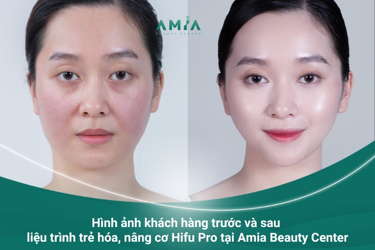 Hình ảnh thực tế khách hàng nâng cơ, trẻ hóa da Hifu Pro tại Amia Beauty Center