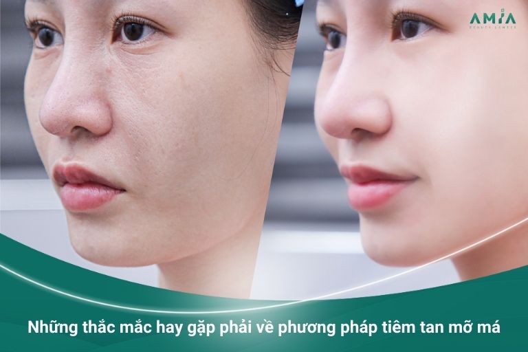 Tiêm tan mỡ má giá bao nhiêu? Có hiệu quả không? Nhung-thac-mac-hay-gap-phai-ve-phuong-phap-tiem-tan-mo-ma