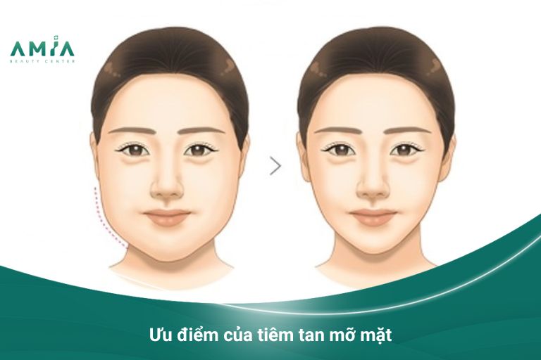 Ưu điểm tuyệt vời của tiêm tan mỡ mặt