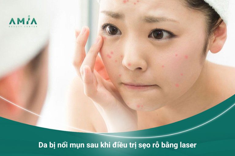 Tình trạng da dễ bị nổi mụn sau khi điều trị