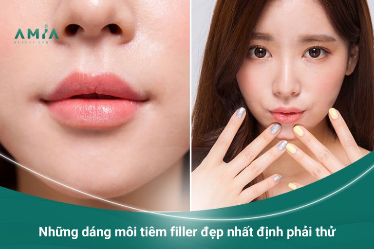 Những dáng môi tiêm filler đẹp nhất định phải thử