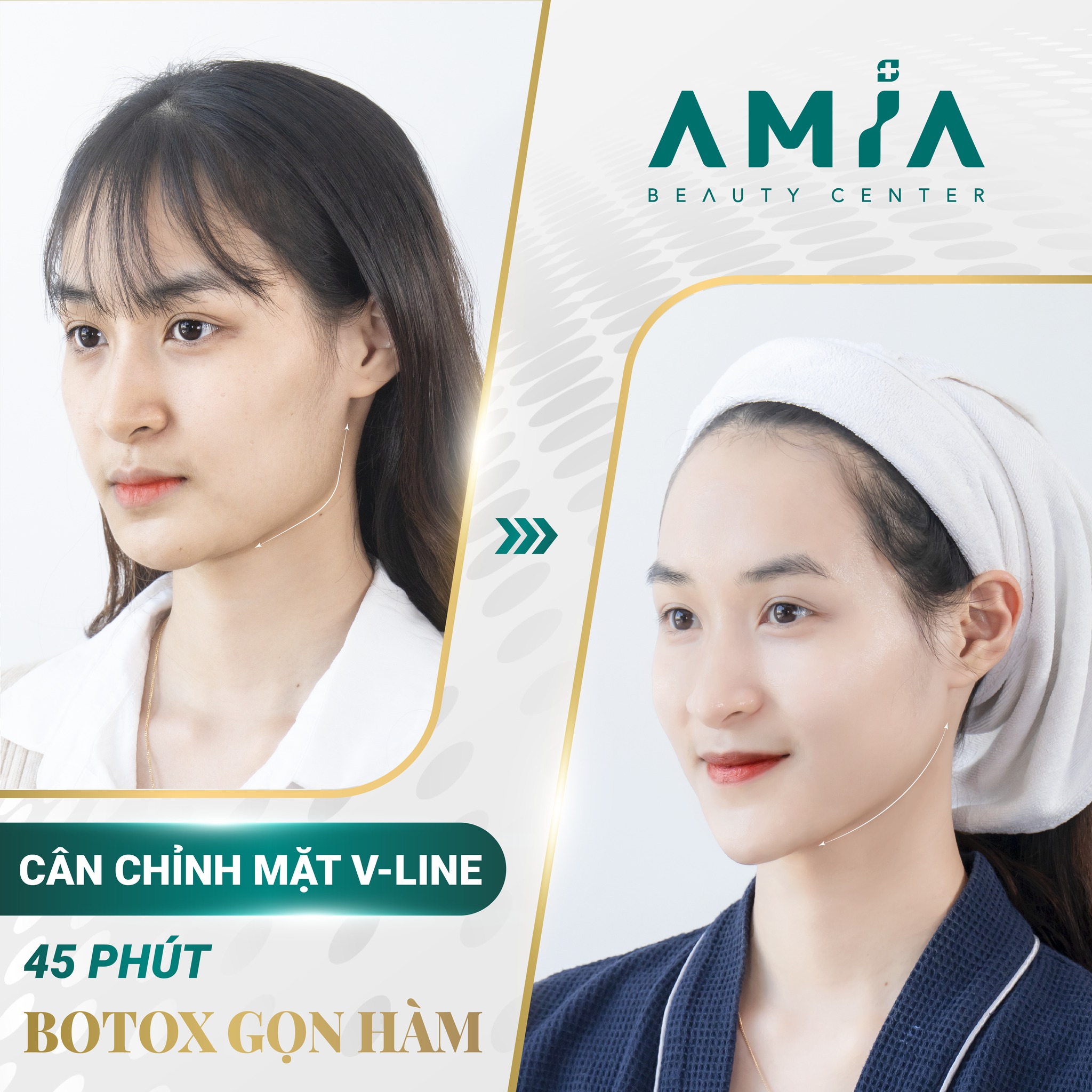 Tiêm botox thon gọn hàm giúp cải thiện tình trạng hàm thô, to, không cân đối