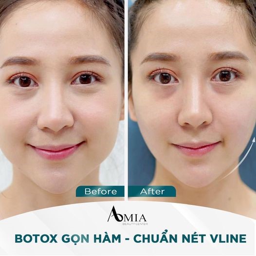 Vẻ đẹp rạng ngời sau khi tiêm botox gọn hàm