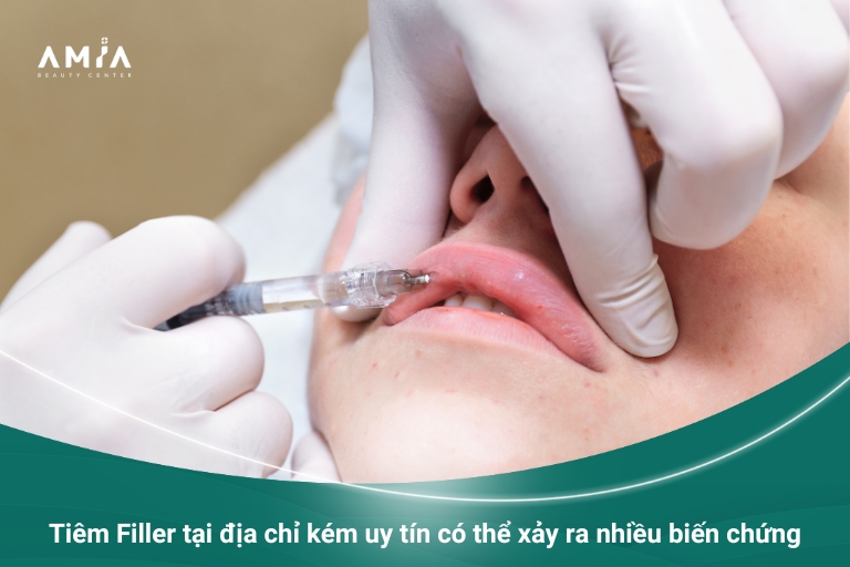 Có nhiều rủi ro xảy ra do tiêm Filler tại những đơn vị thẩm mỹ chui như hoạt tử, viêm nhiễm hay chèn ép động mạch