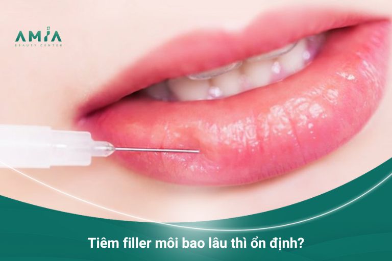 Thời gian ổn định sau khi tiêm filler môi nhanh chóng