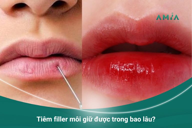 Tiêm filler môi giữ được trong bao lâu?