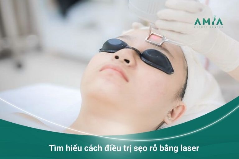 Laser - Một trong những cách điều trị sẹo rỗ phổ biến hiện nay