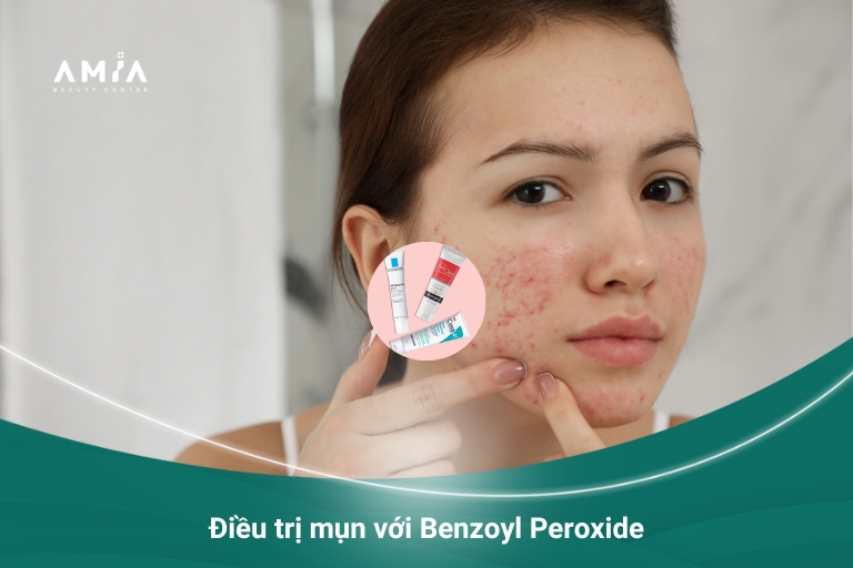 Điều trị mụn với Benzoyl Peroxide