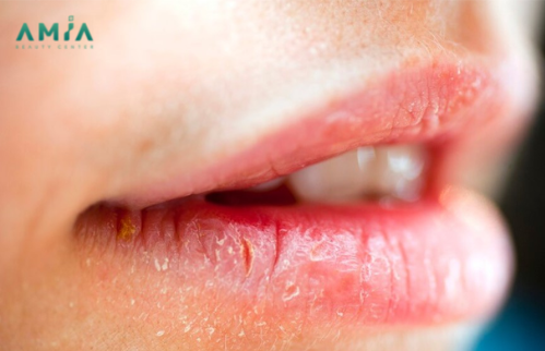 Cách khắc phục phun môi bị bong da nhiều lần 