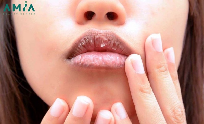 Tổn thương da môi sau khi phun quá nhiều lần