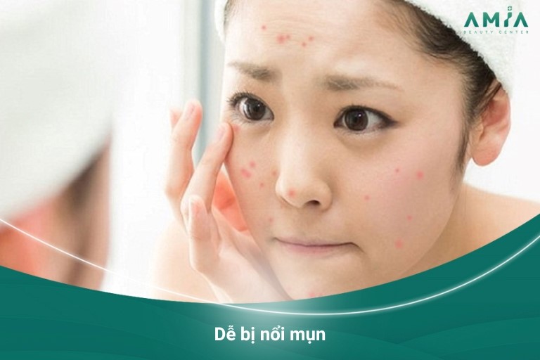 Dễ bị nổi mụn