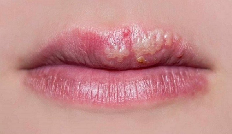 Bôi Acyclovir sau phun môi có bị thâm môi không?