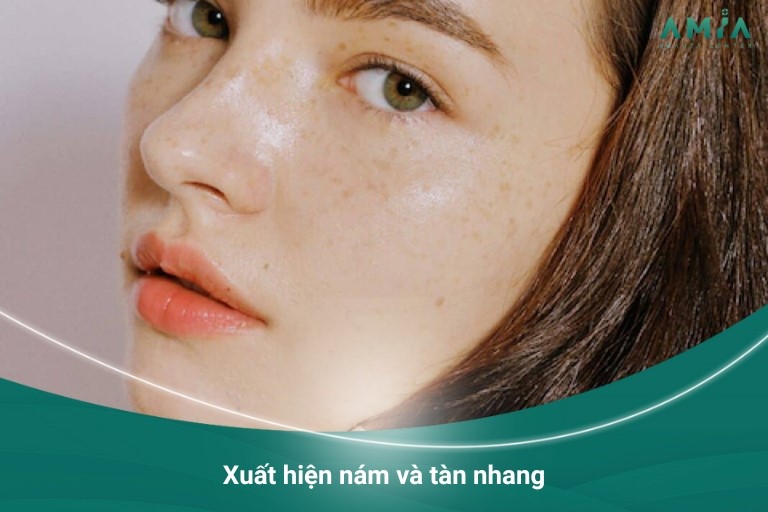 Xuất hiện nám và tàn nhang