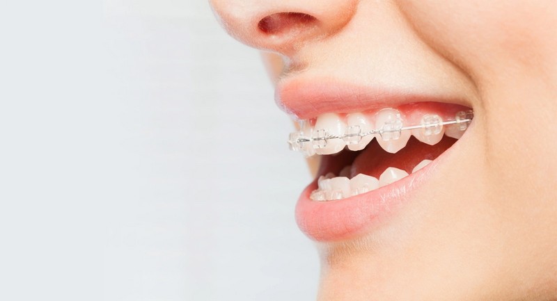 Nên niềng răng nếu bạn sở hữu đôi môi dày răng hô