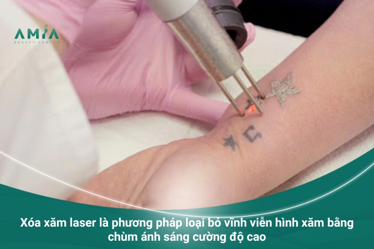 Phương pháp xóa xăm laser