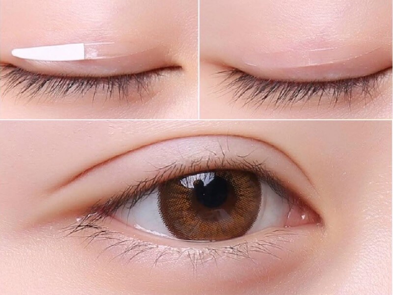 Các kỹ thuật nhấn mí mắt phổ biến hiện nay