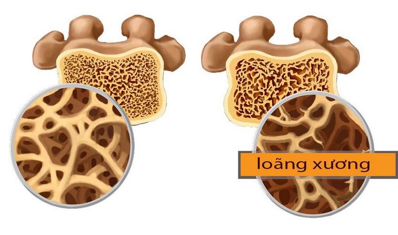 Mất mật độ xương, gia tăng nguy cơ loãng xương