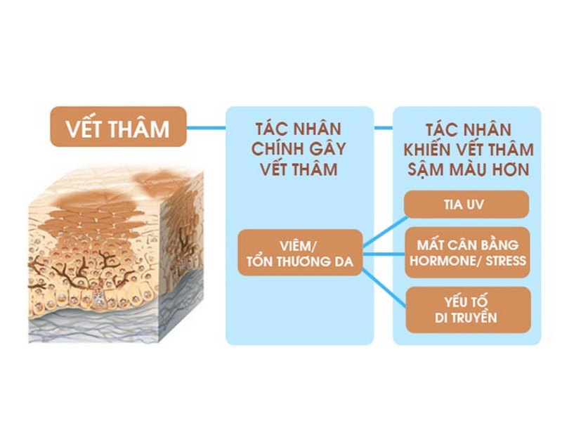 Có một yếu tố di truyền trong việc xác định mức độ nhạy cảm của da với việc hình thành mụn và mụn thâm.